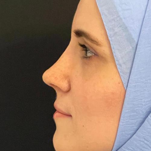 Ultrasound Rhinoplasty Before / After photo